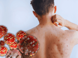 Los síntomas del sarampión pueden aparecer entre 10 y 14 días después del contagio. ESPECIAL / CANVA