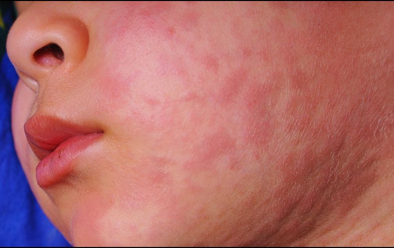 La Secretaría de Salud dio a conocer que en Hidalgo se registran siete casos confirmados de sarampión en los municipios de Pachuca, Actopan y Santiago de Anaya. Se trata de tres menores de edad y cuatro adultos. ESPECIAL / CANVA