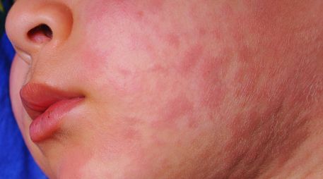 La Secretaría de Salud dio a conocer que en Hidalgo se registran siete casos confirmados de sarampión en los municipios de Pachuca, Actopan y Santiago de Anaya. Se trata de tres menores de edad y cuatro adultos. ESPECIAL / CANVA