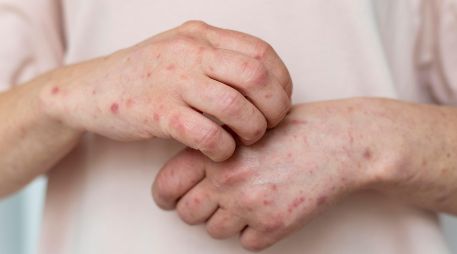 Si presentas fiebre y sarpullido o has estado en contacto con un caso sospechoso, acude de inmediato a tu centro de salud para recibir atención y evitar la propagación. FREEPIK