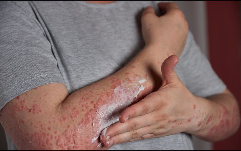 Con los cuidados adecuados, la mayoría de los casos se resuelven sin complicaciones graves. FREEPIk