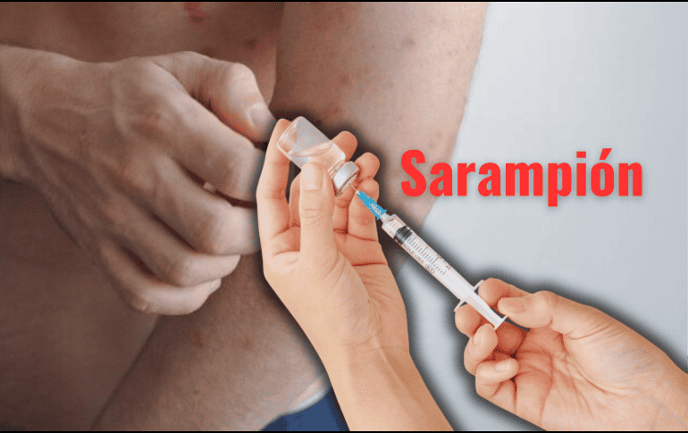 Especialistas de la Universidad Autónoma Metropolitana (UAM) externaron su preocupación ante el brote de sarampión en México. ESPECIAL/Canva