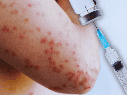 No hay tratamiento específico para el sarampión y la mayoría de los pacientes se recuperan en 2 o 3 semanas. ESPECIAL / CANVA