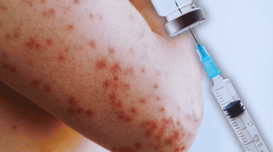 No hay tratamiento específico para el sarampión, y la mayoría de los pacientes se recuperan en 2 ó 3 semanas. ESPECIAL / CANVA