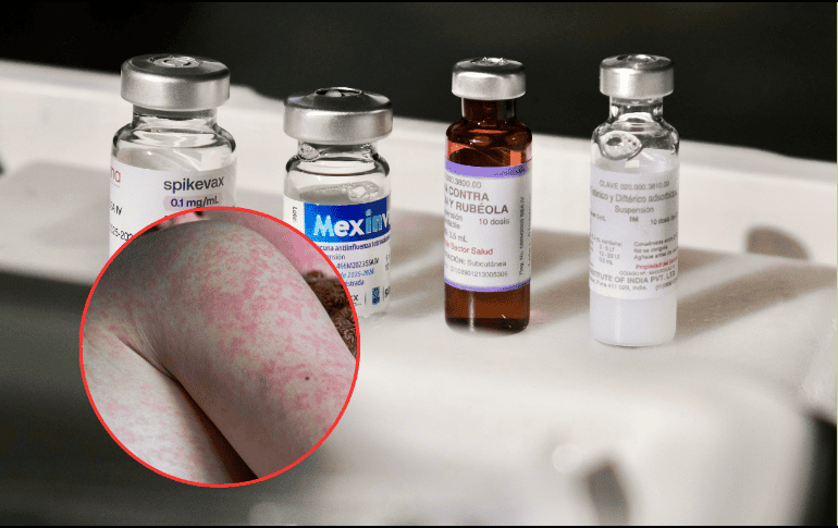 Jalisco ocupa actualmente el segundo lugar a nivel nacional en casos de sarampión registrados este año. ESPECIAL/Gobierno de Jalisco/Canva