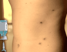 La recomendación general es que la población debe recibir un refuerzo adicional contra el sarampión, sin importar si se trata de menores de edad o personas adultas. ESPECIAL / CANVA