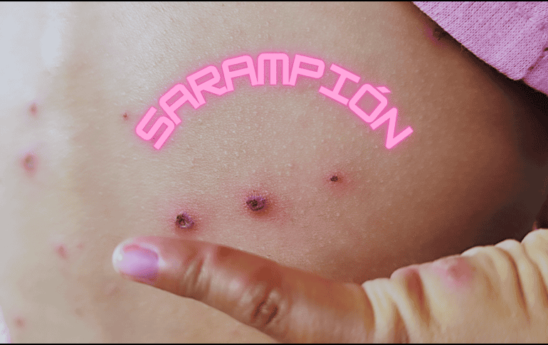 Un solo caso de sarampión puede generar entre 12 y 18 contagios en personas susceptibles. ESPECIAL / CANVA