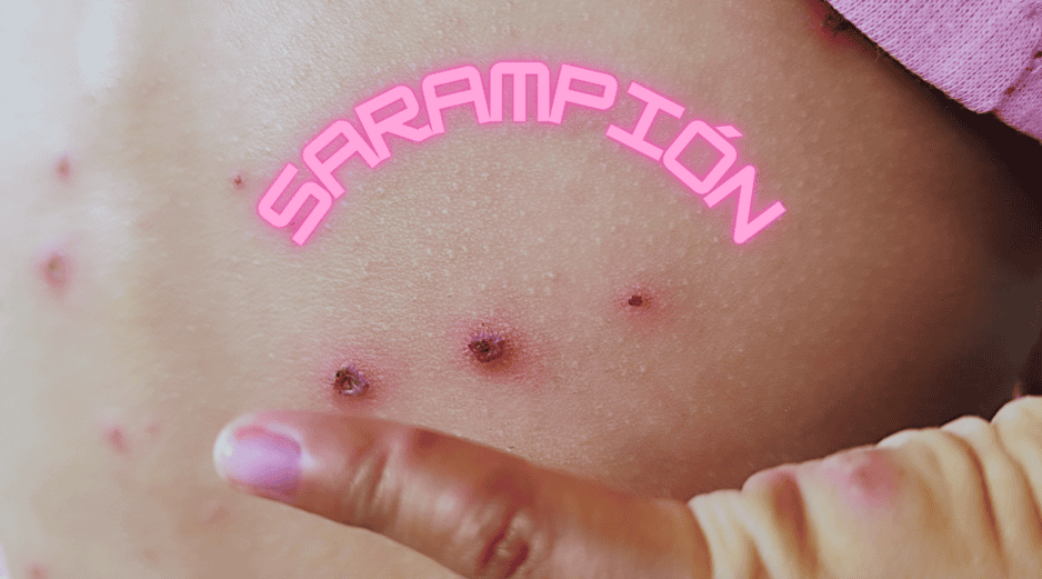 Un solo caso de sarampión puede generar entre 12 y 18 contagios en personas susceptibles. ESPECIAL / CANVA