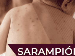 Las autoridades invitan a la población a acudir al  Centro de Salud o módulo de vacunación más cercano para recibir la vacuna contra el sarampión. Gobierno de México