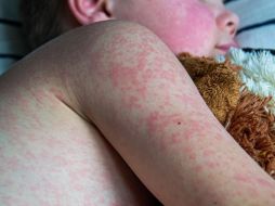 Jalisco confirmó 665 casos de sarampión en 2025, y mil 432 casos en lo que va de 2026, para dar un total de 2 mil 97 contagios. ESPECIAL/Canva