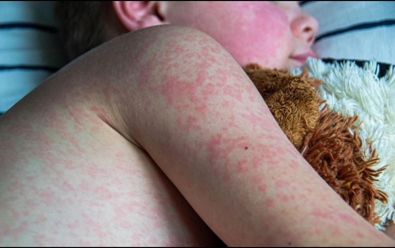 Jalisco confirmó 665 casos de sarampión en 2025, y mil 432 casos en lo que va de 2026, para dar un total de 2 mil 97 contagios. ESPECIAL/Canva