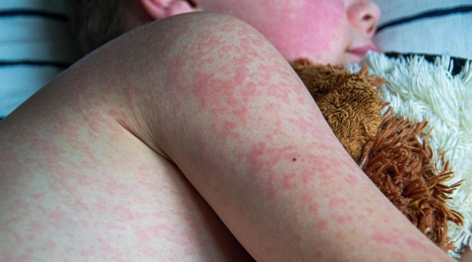 Jalisco confirmó 665 casos de sarampión en 2025, y mil 432 casos en lo que va de 2026, para dar un total de 2 mil 97 contagios. ESPECIAL/Canva