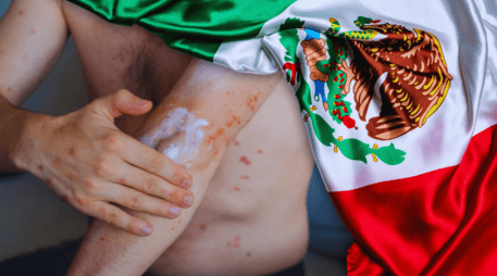 De acuerdo con cifras oficiales, entre 2025 y 2026 se han registrado 9 mil 74 casos acumulados de sarampión en México. ESPECIAL / CANVA