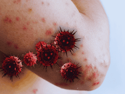 El riesgo del sarampión no se limita a la erupción cutánea, sino a las secuelas permanentes que puede dejar en el organismo. ESPECIAL / CANVA