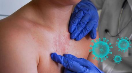 La manifestación clínica del sarampión ocurre días después del contagio inicial. PEXELS/ESPECIAL