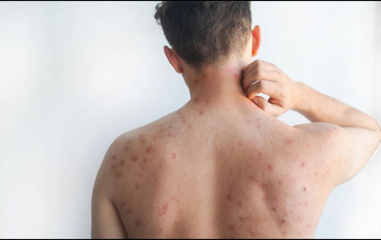 La titular de Salud capitalina detalló que actualmente se han confirmado poco más de 180 casos de contagio en la ciudad.  CANVA