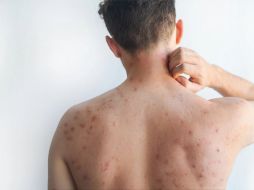 La titular de Salud capitalina detalló que actualmente se han confirmado poco más de 180 casos de contagio en la ciudad.  CANVA