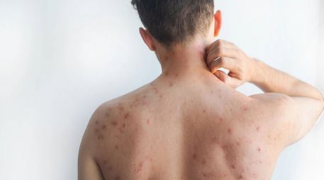 La titular de Salud capitalina detalló que actualmente se han confirmado poco más de 180 casos de contagio en la ciudad.  CANVA