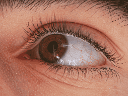 La miopía se desarrolla cuando la iluminación deficiente de la retina no genera una actividad retiniana sólida. ESPECIAL