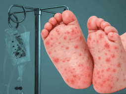 En un comunicado, la dependencia estatal precisó que, aunque no se cuenta con un diagnóstico confirmado por laboratorio, el hermano gemelo del menor dio positivo a la prueba de sarampión. Unsplash