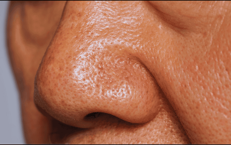 El síndrome de la nariz vacía puede ocasionar aturdimiento, mareos e incapacitar al paciente para realizar sus funciones diarias. ESPECIAL / CANVA