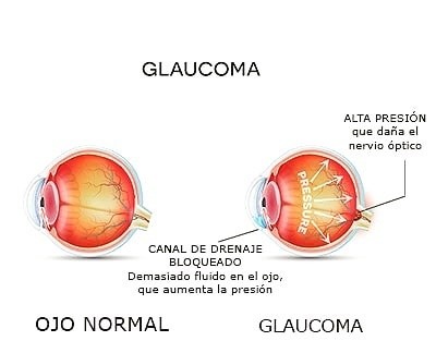 El glaucoma afecta directamente el nervio óptico comprometido su  funcionalidad. INSTAGRAM/@agafglaucoma